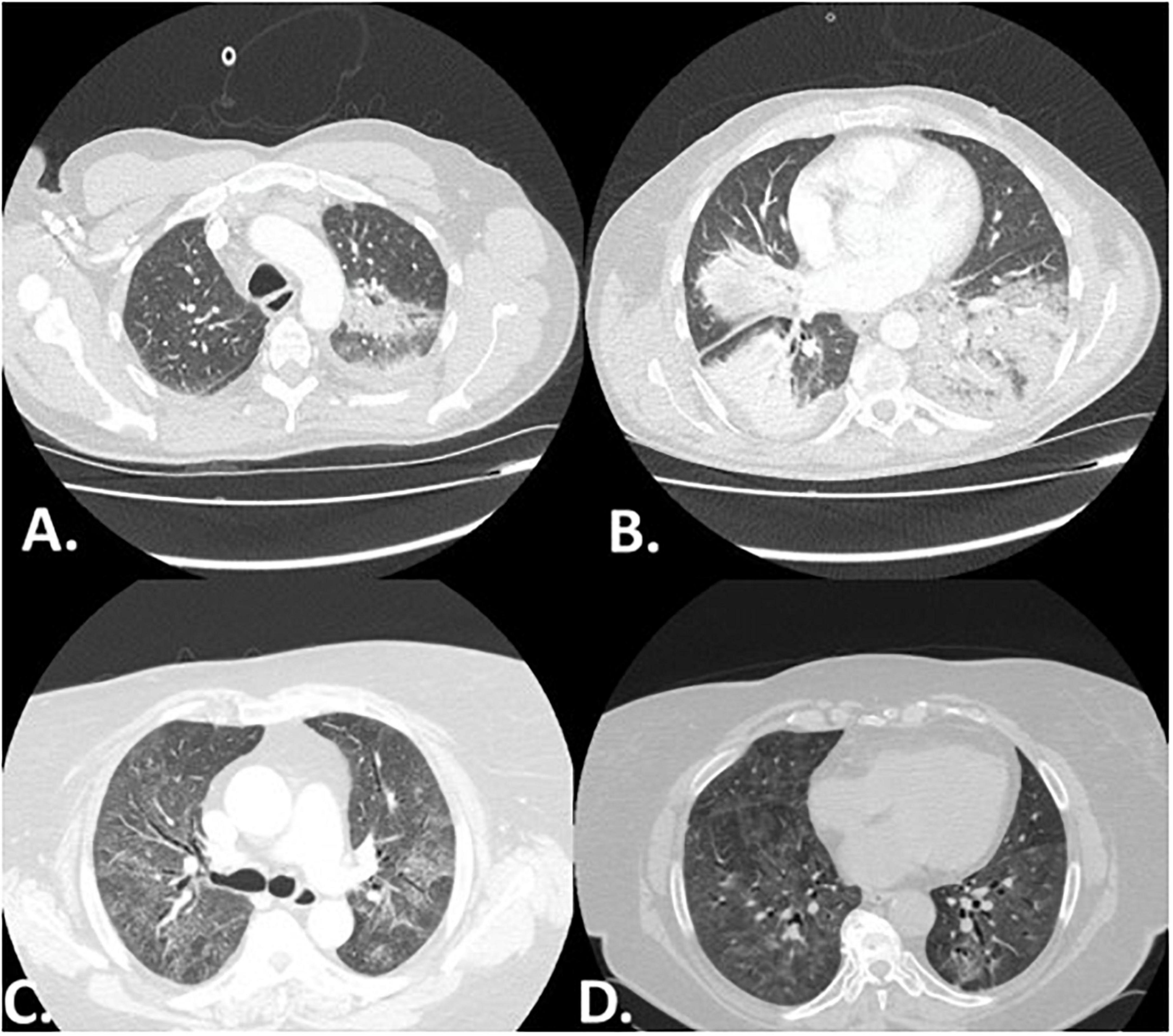 Clinical features and outcomes of patients with myositis associated-interstitial lung disease